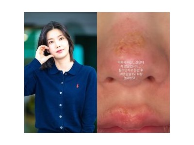 권은비 킬리만자로 등반 중 화상 입어 팬들 충격